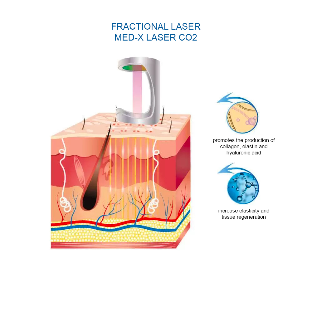 фракционные лазеры CO2