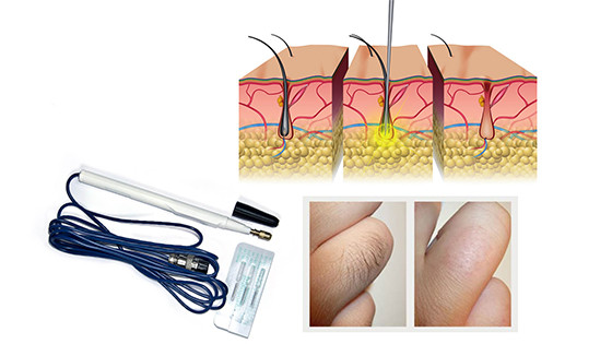 аппараты для электроэпиляции alvi prague