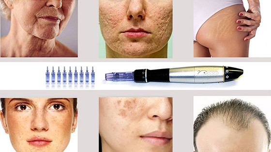 microneedling pen apvi prague 
